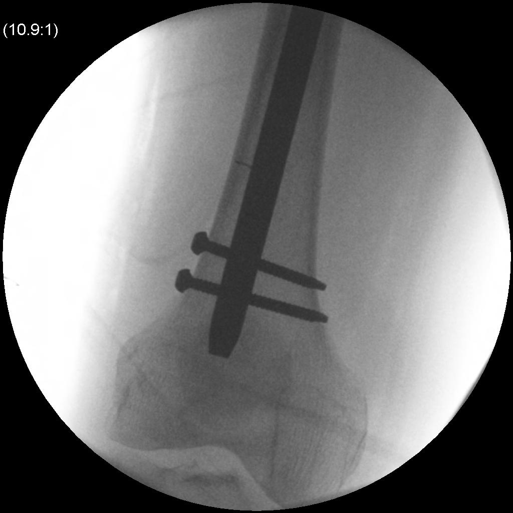 Femoral Nail Distal Locking0002